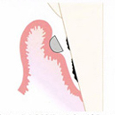 キュレットは歯周ポケット内へ挿入し、根面に対してキュレットの表面の角度が0に近いことに注意します。